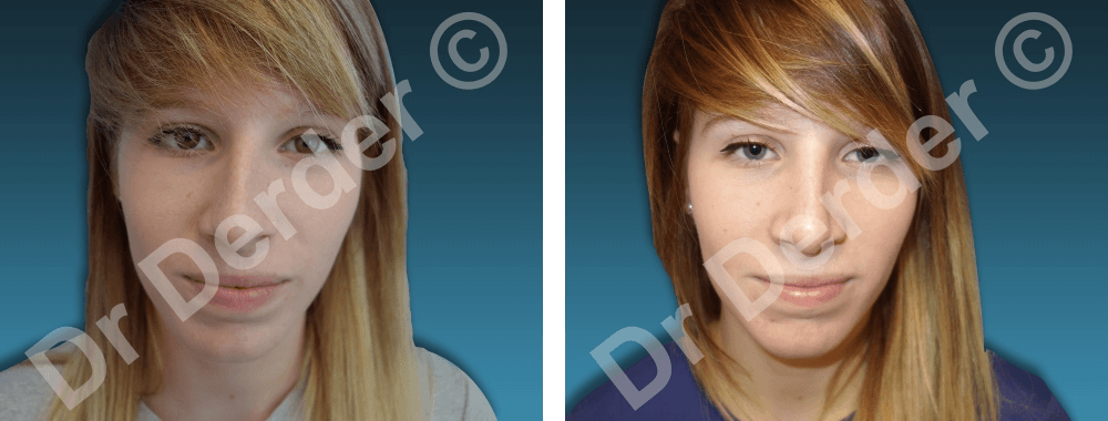 Rhinoplastie — résultat avant et après