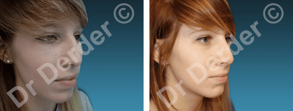 Rhinoplastie — résultat avant et après