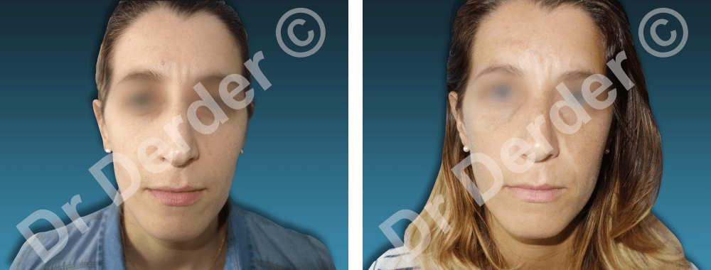 Rhinoplastie — résultat avant et après