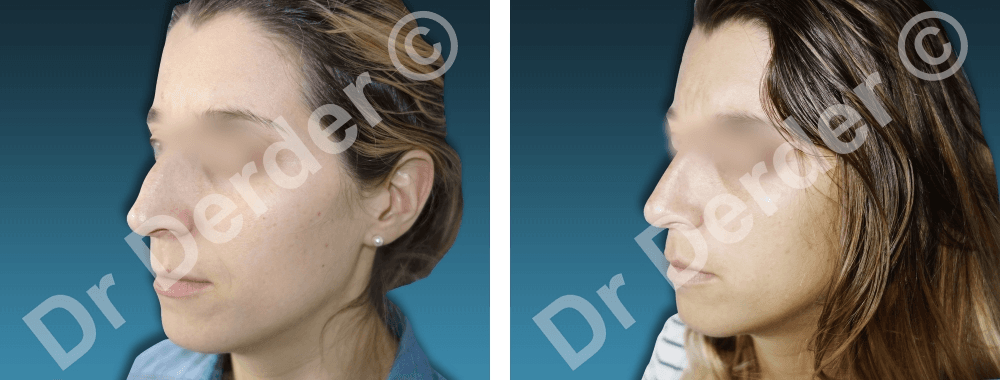 Rhinoplastie — résultat avant et après