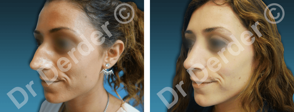 Rhinoplastie — résultat avant et après