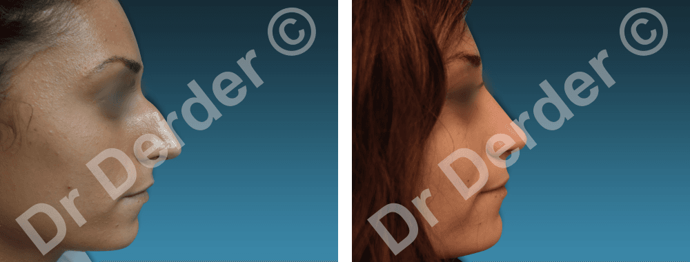 Rhinoplastie — résultat avant et après