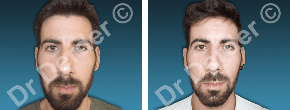 Rhinoplastie — résultat avant et après