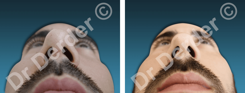 Rhinoplastie — résultat avant et après