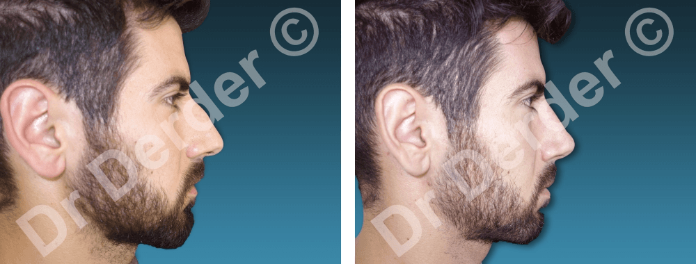 Rhinoplastie — résultat avant et après