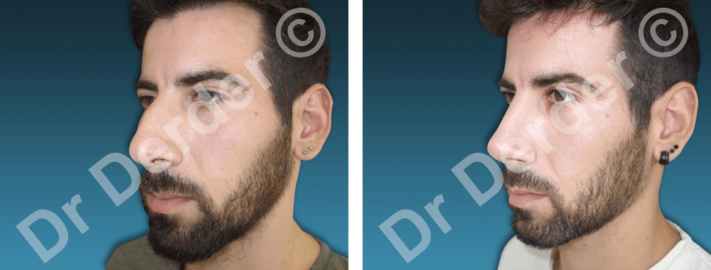 Rhinoplastie — résultat avant et après