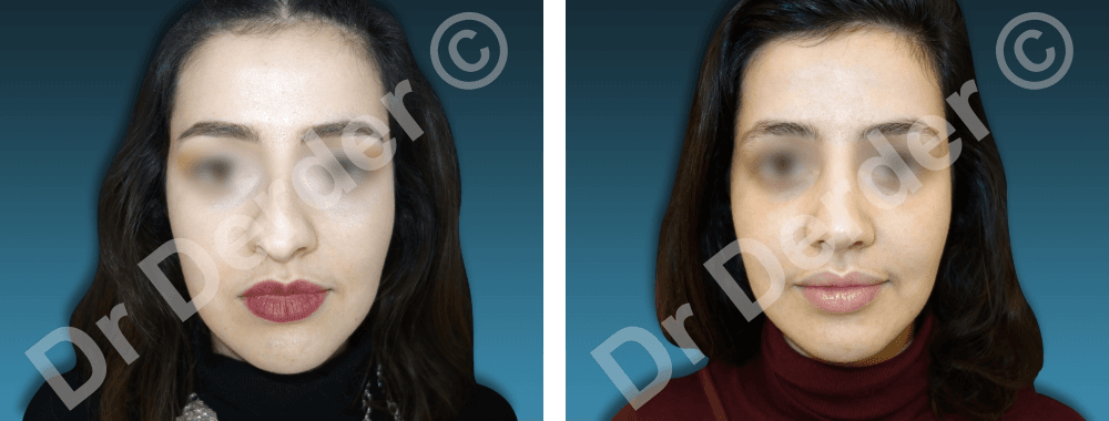 Rhinoplastie — résultat avant et après