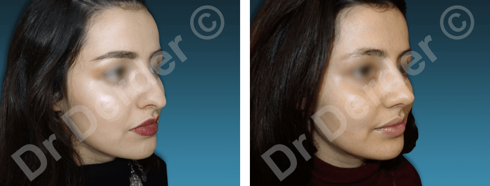 Rhinoplastie — résultat avant et après