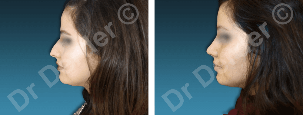 Rhinoplastie — résultat avant et après