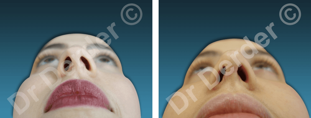 Rhinoplastie — résultat avant et après