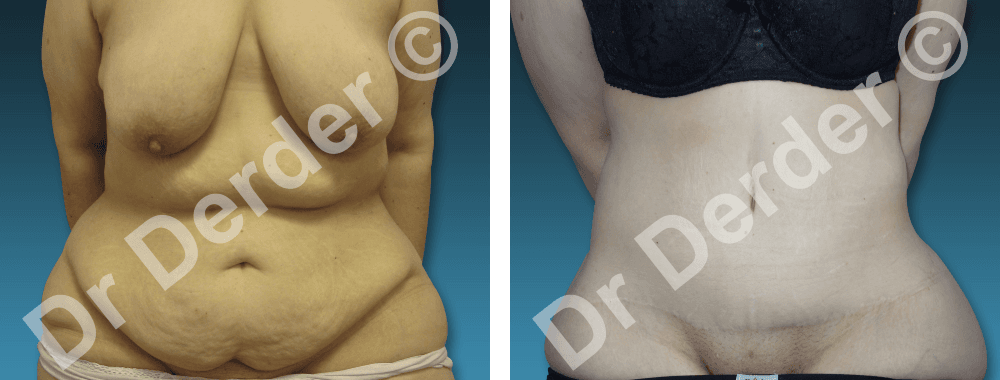 Résultat Chirurgie de la silhouette — photographie avant et après