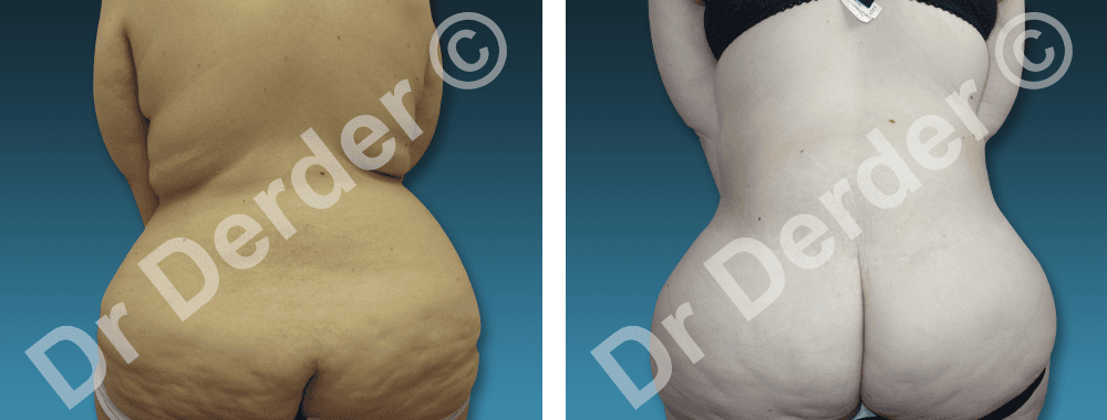 Chirurgie de la silhouette — résultat avant et après