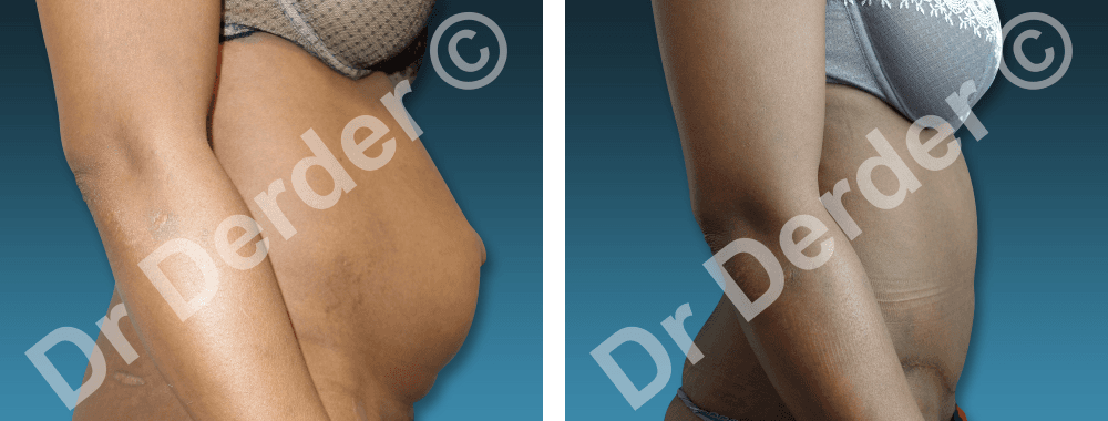 Chirurgie de la silhouette — résultat avant et après