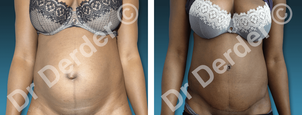 Chirurgie de la silhouette — résultat avant et après
