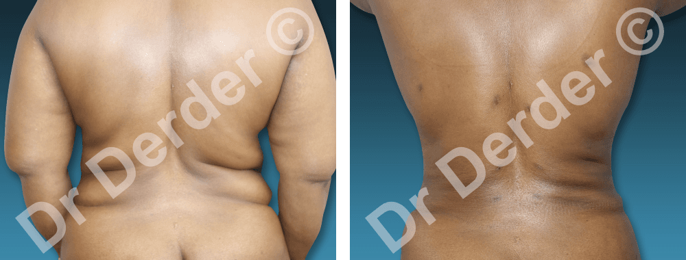 Chirurgie de la silhouette — résultat avant et après