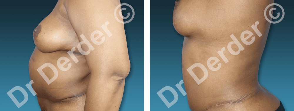 Chirurgie de la silhouette — résultat avant et après