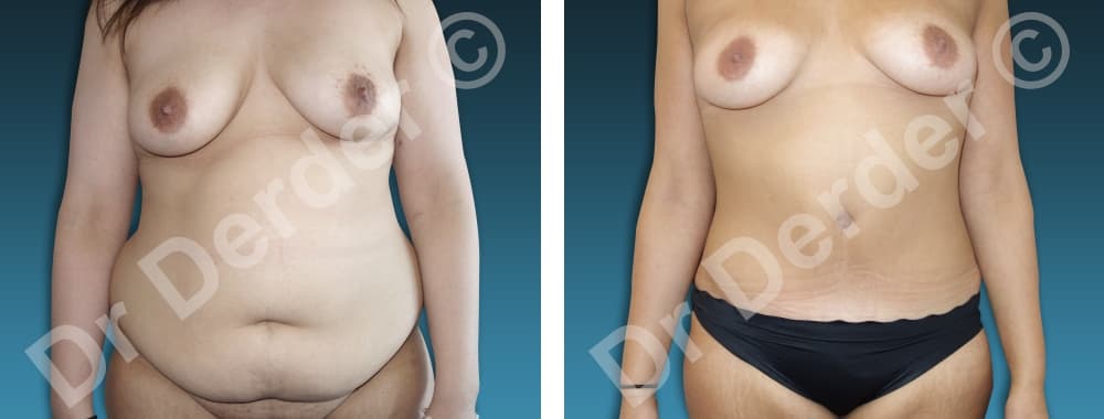 Chirurgie de la silhouette — résultat avant et après