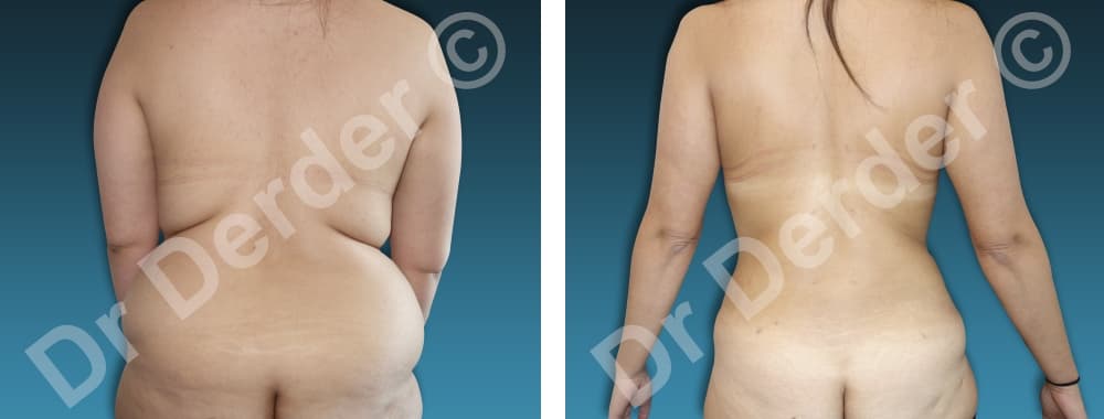 Chirurgie de la silhouette — résultat avant et après
