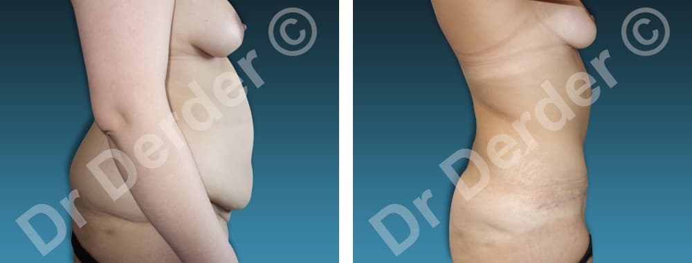 Chirurgie de la silhouette — résultat avant et après