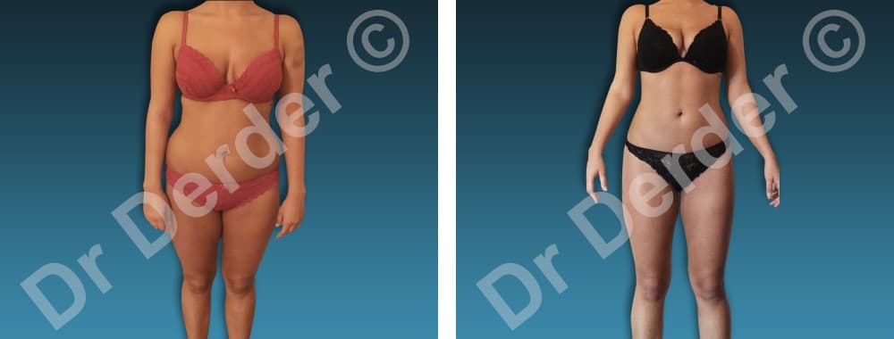Chirurgie de la silhouette — résultat avant et après