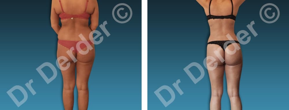 Chirurgie de la silhouette — résultat avant et après