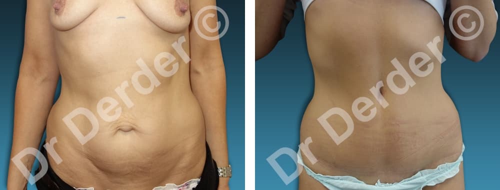 Chirurgie de la silhouette — résultat avant et après