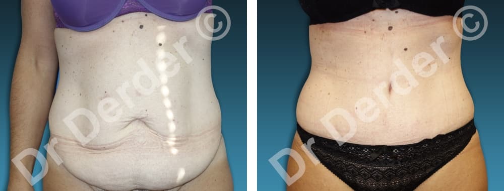 Chirurgie de la silhouette — résultat avant et après