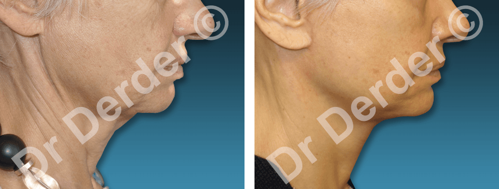 Résultat Chirurgie du visage — photographie avant et après