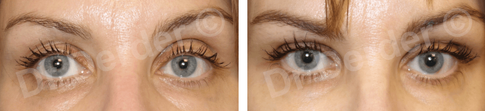 Chirurgie du visage — résultat avant et après