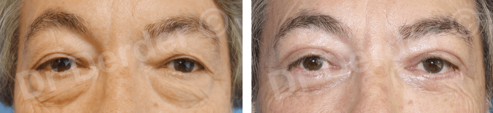 Chirurgie du visage — résultat avant et après