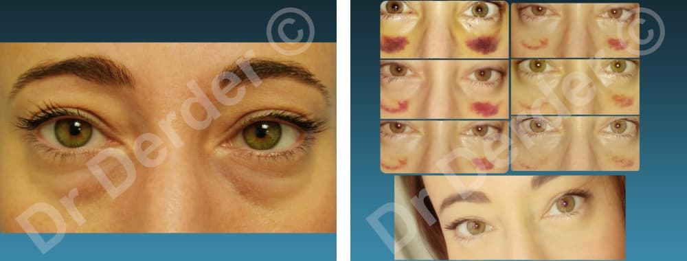 Chirurgie du visage — résultat avant et après