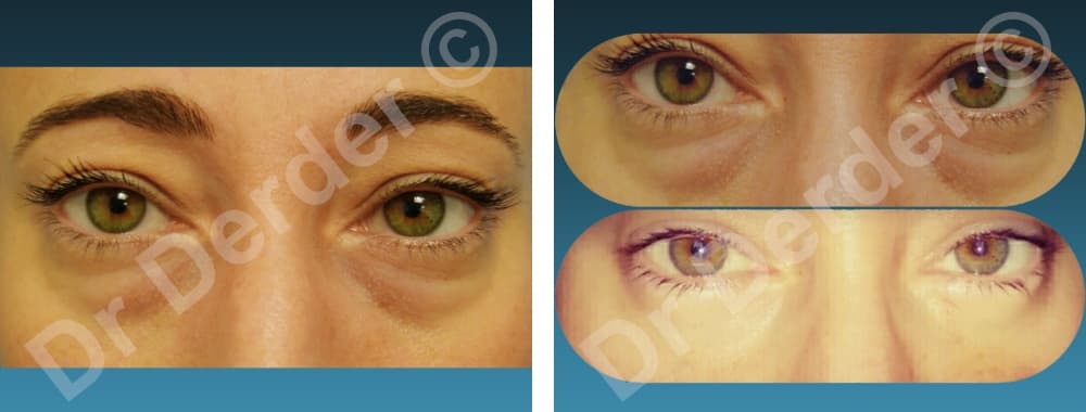 Chirurgie du visage — résultat avant et après