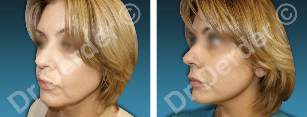 Chirurgie du visage — résultat avant et après