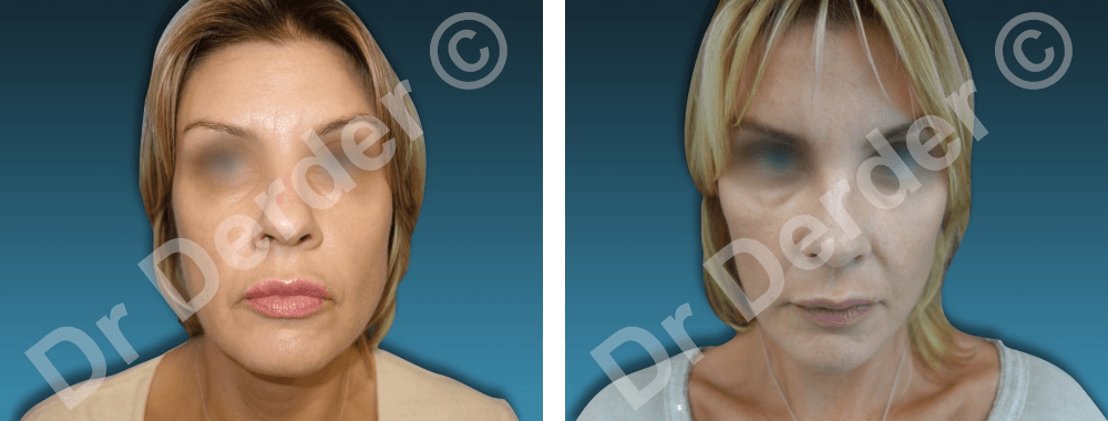 Chirurgie du visage — résultat avant et après